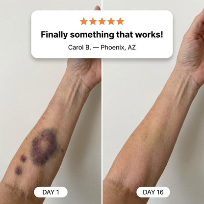 💥100K+ SOLD💕- Omumax® Bruise Repair & Skin-Strengthening Cream